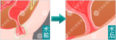 肛瘘手术前后对比