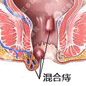 混合痔的专业治疗方法