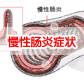 慢性肠炎的临床表现