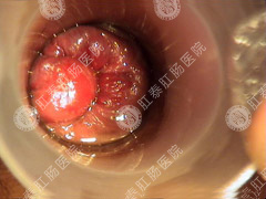 什么是肛周包块和肛门赘
