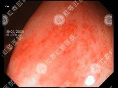 急性肠炎要做什么检查