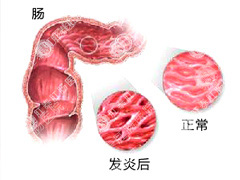 急性肠炎怎么治疗?