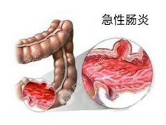 急性肠炎的专业治疗方法?