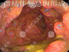 怎么确定得了结肠炎?
