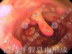 顽固性结肠炎专业的治疗方法?