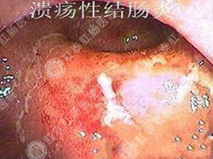 顽固性结肠炎怎么检查
