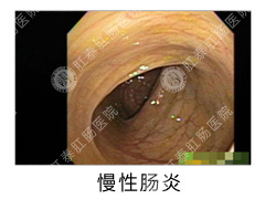 慢性肠炎的并发症有哪些？
