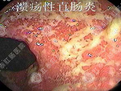 直肠炎发生的诱因是什么