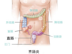 直肠炎的病因