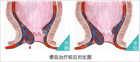肛门出血是怎么回事