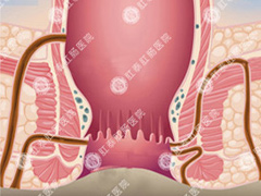 肛瘘如何检查和治疗