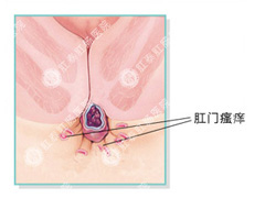 女性肛门瘙痒是怎么回事