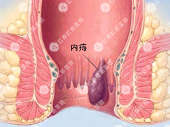 内痔如何治效果果专业
