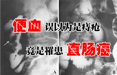  便血误以为是痔疮竟是罹患直肠癌